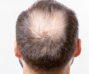 Understanding Male Pattern Baldness: Androgenetic Alopecia